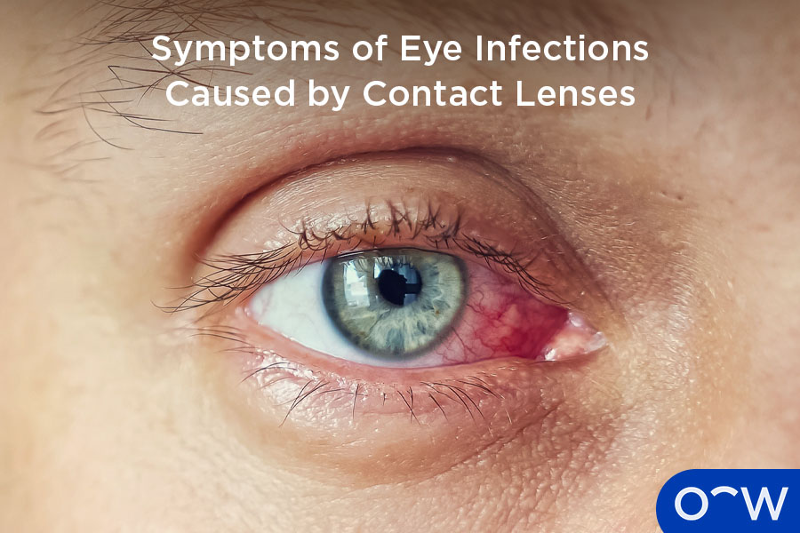 An eye affected by an eye infection caused by contact lenses.