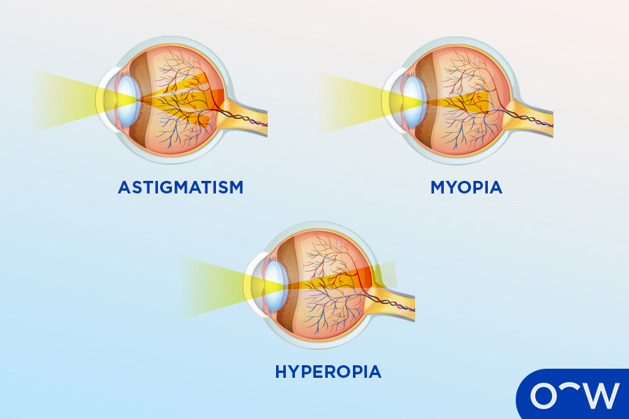Three eyeballs representing each refractive error, which are astigmatism, myopia, and hyperopia.