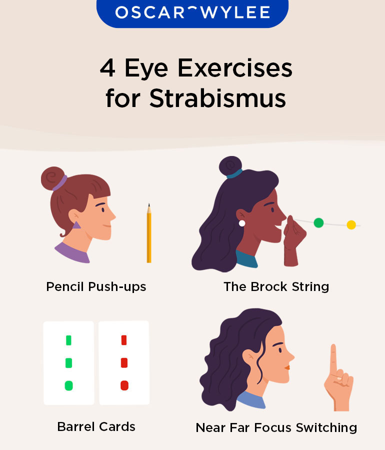 Strabismus and Eye Exercises for It