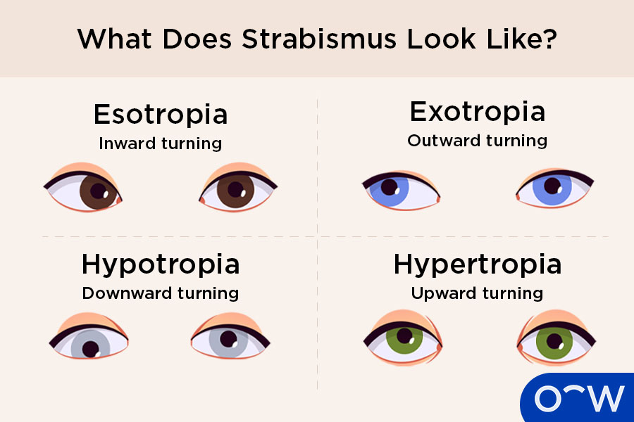 Four squares, each with a different type of strabismus demonstrated including esotropia or inward turning, exotropia or outward turning, hypotropia downward turning and hypertropia or upward turning
