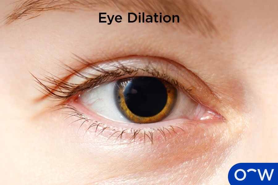 A dilated pupil as a result of pupil-dilating eye drops.