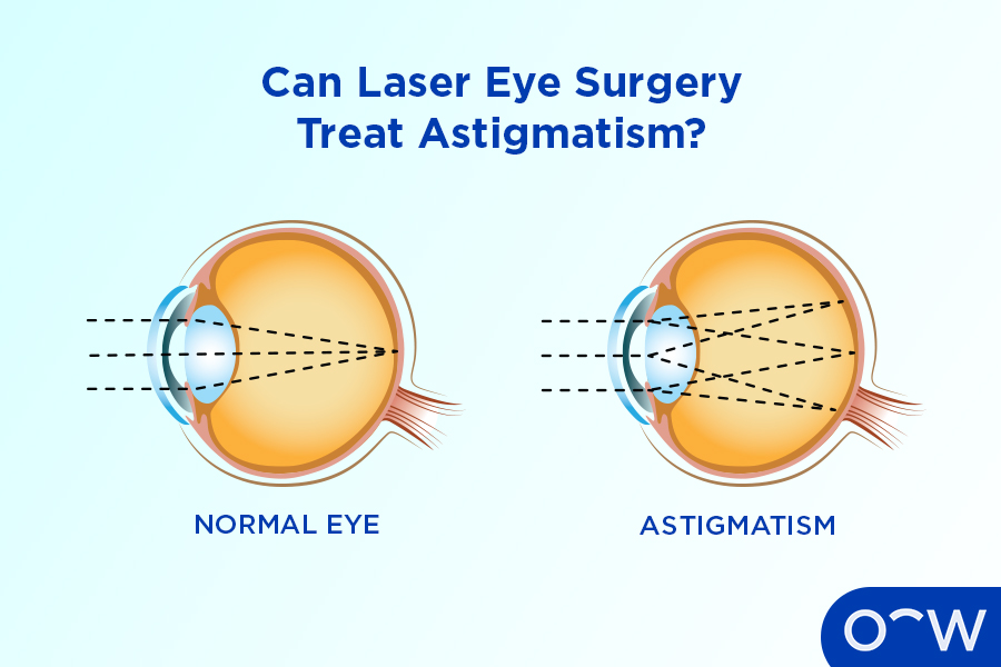 A diagram of a normal eye, with one focal point, next to a diagram of an eye with astigmatism, with multiple focal points.