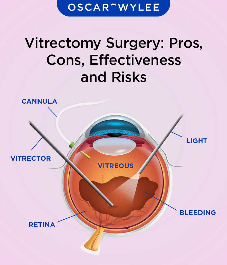 Vitrectomy Surgery.