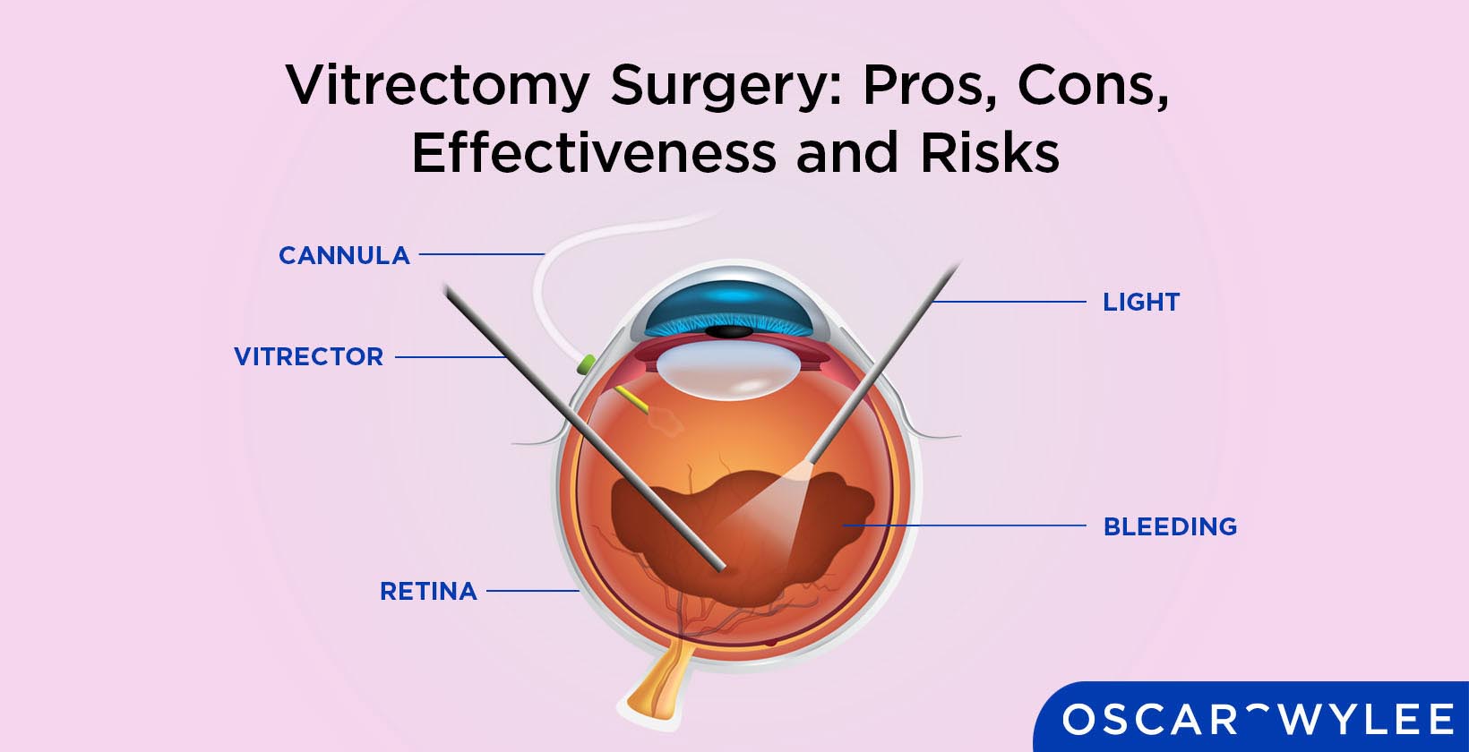 Vitrectomy Surgery.