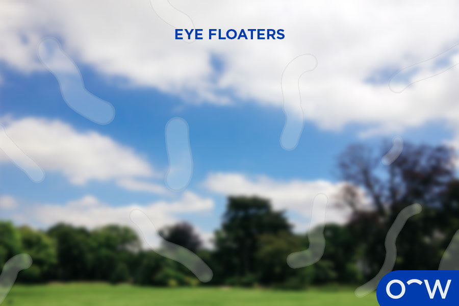 A person’s vision affected by eye floaters.
