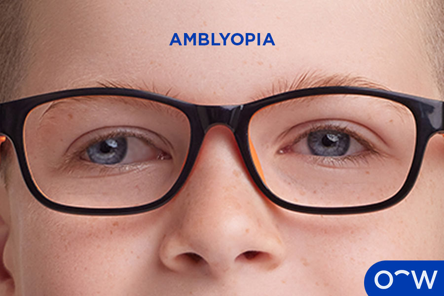 Child's eyes exhibiting the common eye problem lazy eye (amblyopia).