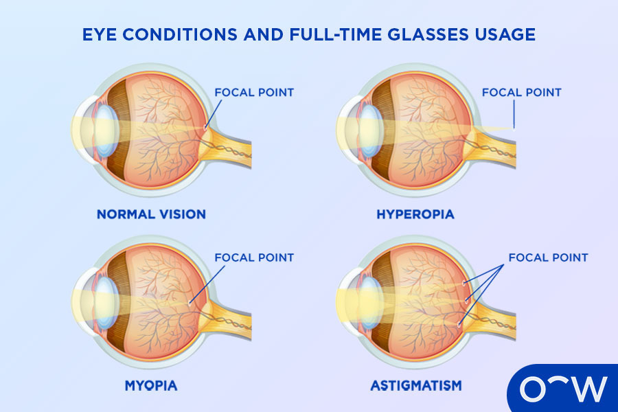 Cross sections of four different eyeballs, one normal and three demonstrating a common eye condition including astigmatism, myopia and hyperopia.